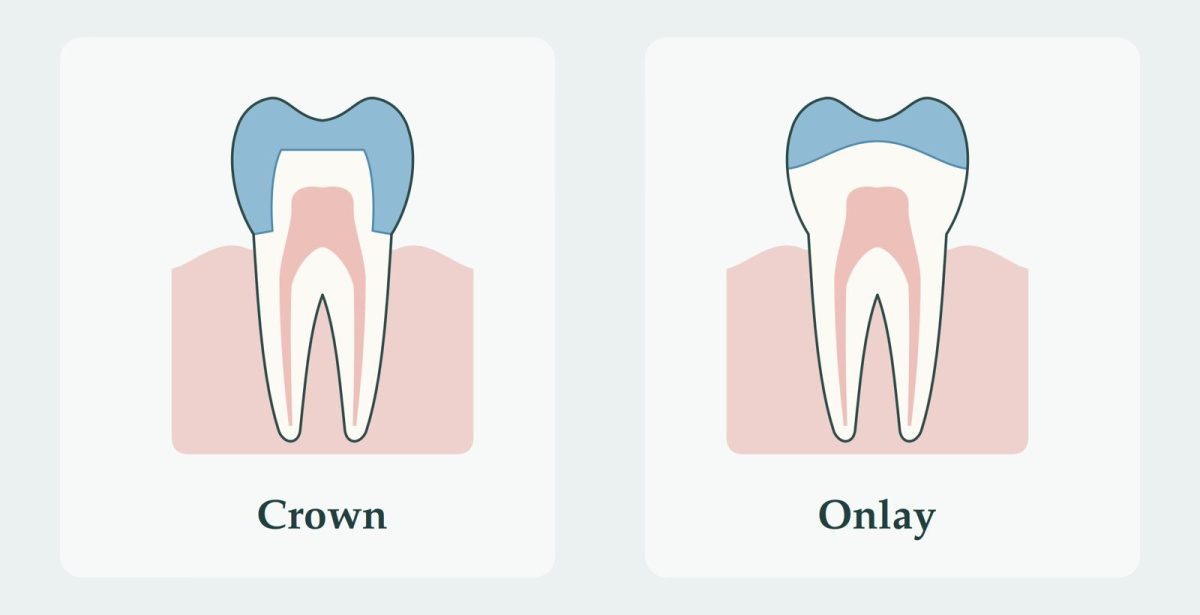 A picture showing the difference between a crown and onlay